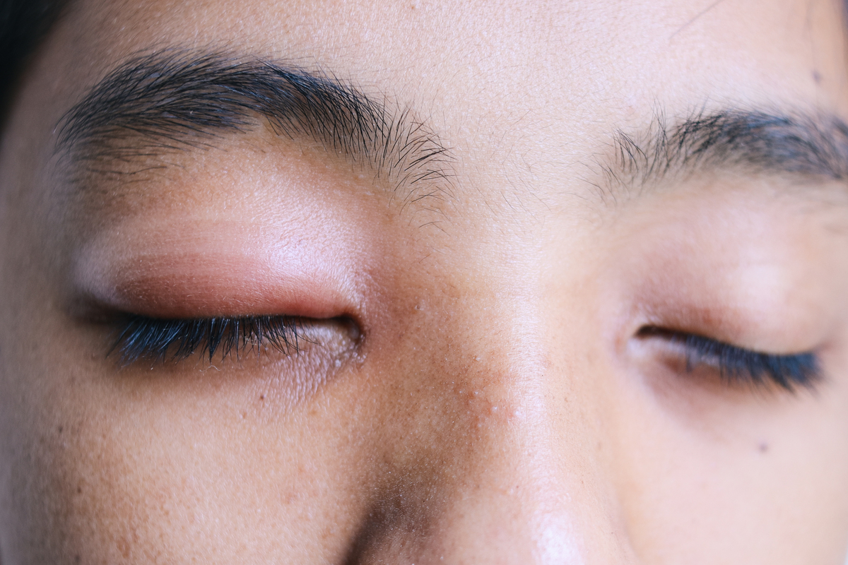 puffy eyes
