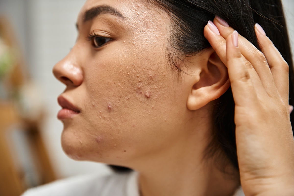 woman looking at her acne