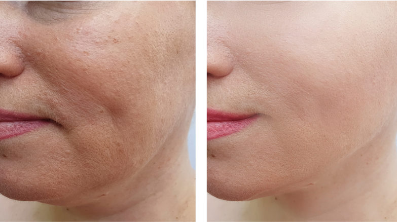 before and after of textured skin to smooth skin